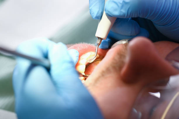 Best Broken or Chipped Tooth Repair in Palos Verdes Estates, CA